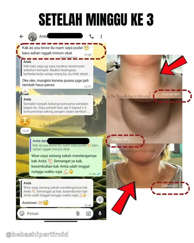 Perubahan kondisi leher Anita setelah minggu ketiga