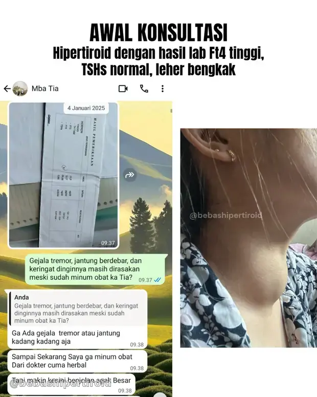 Kondisi awal Tia saat konsultasi dengan hipertiroid toxic nodul dan pembengkakan leher