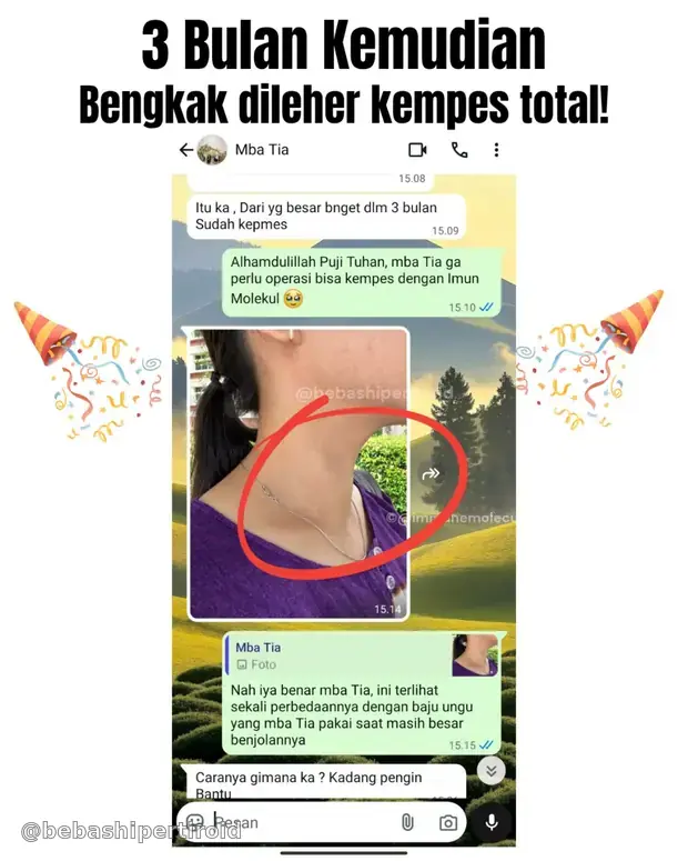 Kondisi leher Tia tiga bulan kemudian setelah pembengkakan kempes