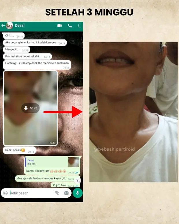 Perubahan pembengkakan leher Desi setelah tiga minggu menjalani proses pemulihan