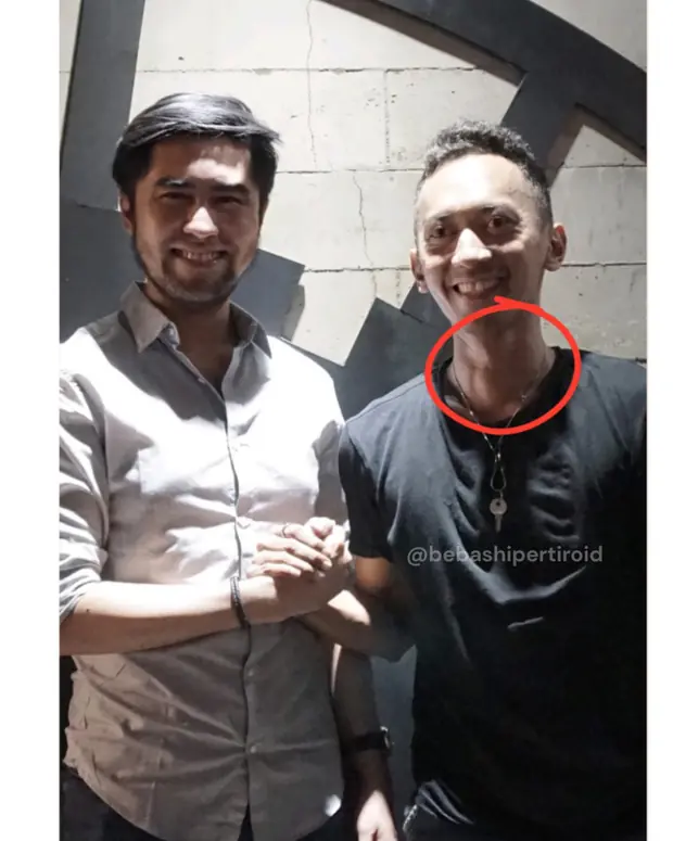 Kondisi Cliff sebelum pulih dari hipertiroid, foto 2